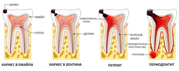 Ендодонтията